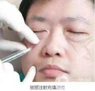 玻尿酸填充淚溝的副作用是什么?