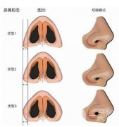 鼻翼內(nèi)切需要多長時間恢復(fù)?