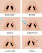 鼻翼內(nèi)切的價格是多少?