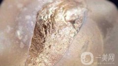 液體隆胸材料有哪些?