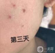 藥水點痣和激光點痣的原理，及優(yōu)缺點