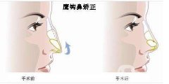 鷹鉤鼻是否可以整形?可以矯正嗎?