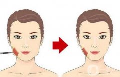 嬰兒肥可以注射*嗎，*注射幾次可以定型