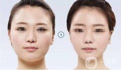 整容后還可以坐飛機(jī)嗎?