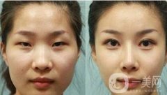 怎么樣是開眼角手術(shù)后*好的護(hù)理