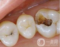 用什么材料補(bǔ)牙洞好？