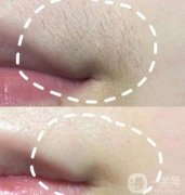 激光脫唇毛前注意事項(xiàng)!每次去唇毛要多久?