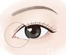 開內(nèi)眼角手術(shù)多少錢?多久可以恢復(fù)?