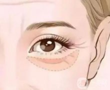 怎么消除對(duì)去眼袋的誤解?內(nèi)切眼袋手術(shù)后應(yīng)該如何護(hù)理?