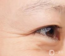 魚尾紋打玻尿酸有用嗎？玻尿酸注射魚尾紋是否*？