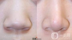 鼻翼縮小多長(zhǎng)時(shí)間可以化妝，鼻翼縮小的果如何