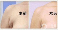 副乳與乳腺增生有什么區(qū)別?