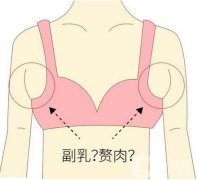 副乳切除術(shù)有沒有影響?