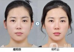 打*多少次可以定型?*注射三次可以*嗎?