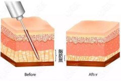 抽脂會(huì)不會(huì)反彈，抽脂應(yīng)該注意什么