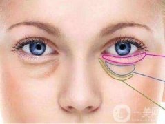 超聲法去眼袋的危害是什么?