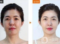 玻尿酸填充法令紋消腫需要多長時間?