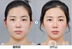 國產(chǎn)瘦臉*怎么樣?好嗎?