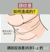 嗨體去頸紋能持續(xù)多久?