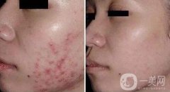 果酸換膚和光子嫩膚哪個(gè)更好?