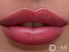 豐唇需要多少錢?豐唇疼嗎?