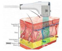 *是否會影響懷孕，*除皺的優(yōu)缺點(diǎn)