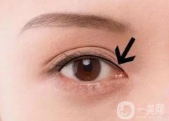 紋了美瞳線后眼睛腫應該怎么辦？