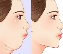 雙下巴溶脂*嗎?雙下巴怎么溶脂?