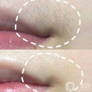 多久剪一次唇毛?脫唇毛每次間隔多久?