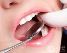 洗牙會有痛感嗎？刷牙可以代替洗牙嗎?