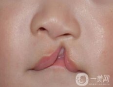 唇腭裂分類有哪些?唇腭裂修復(fù)前的注意事項有哪些?