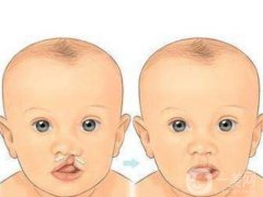 唇腭裂的致病因素是什么?