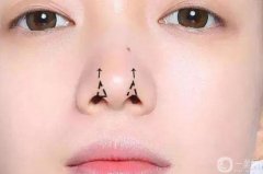 達拉斯隆鼻手術(shù)需要多少錢？