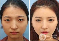 開內(nèi)眼角會不會留下傷疤呢，留疤了怎么辦