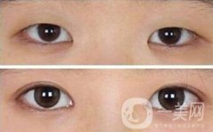 開眼角拆線后洗臉需要注意什么，開眼角術(shù)后怎么護(hù)理?