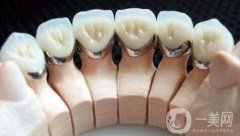 烤瓷牙和牙套的不同，烤瓷牙和牙冠的不同