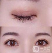 埋線雙眼皮存在風險后遺癥嗎?