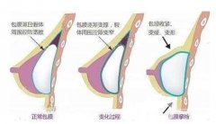 隆胸和真胸的區(qū)別，以及隆胸和真胸的手感差異