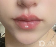 隆唇手術的價格大概是多少?