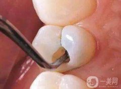 補牙洞需要多少次完成？