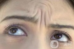 川字紋是否可以打玻尿酸?