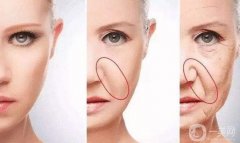 法令紋形成的原因是什么？填充法令紋的風險