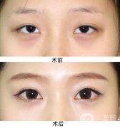 開內(nèi)眼角會不會回縮，哪些人適合，哪些人不適合?