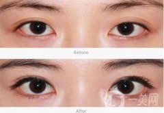 開眼角拆線后如何清潔眼睛，開眼角前后的注意事項有哪些?