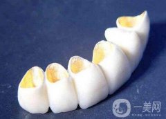 烤瓷牙對(duì)身體有害嗎，烤瓷牙有哪些檢查?