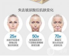 玻尿酸有什么作用?常見玻尿酸產(chǎn)品介紹