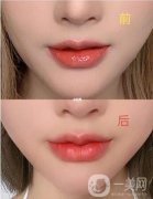 玻尿酸隆唇怎么樣?玻尿酸隆唇術(shù)后的注意事項