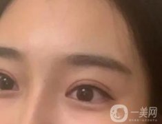 雙眼皮手術(shù)后應(yīng)該注意什么?事項仔細看看！
