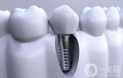 種植牙一顆多少錢(qián)？種植牙的優(yōu)點(diǎn)