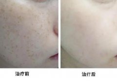 *能讓皮膚變薄嗎？什么是超*激光？